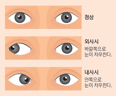 14면_유소아기눈관리