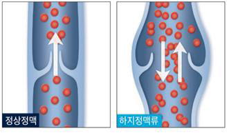 ] 정상 정맥과 하지정맥류 발생 혈관 차이