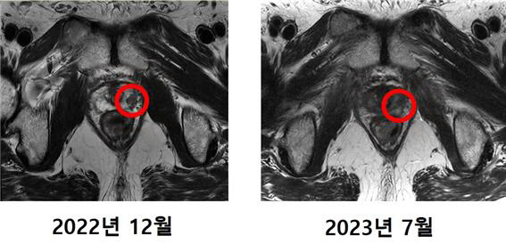 첫 중입자치료 환자 MRI 비교 사진