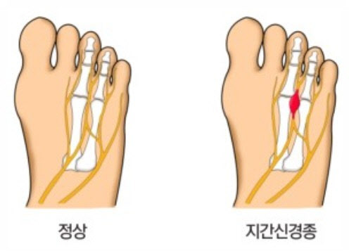 지간신경종