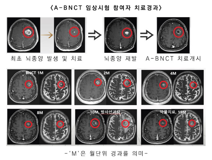 가천대 길병원 뇌암